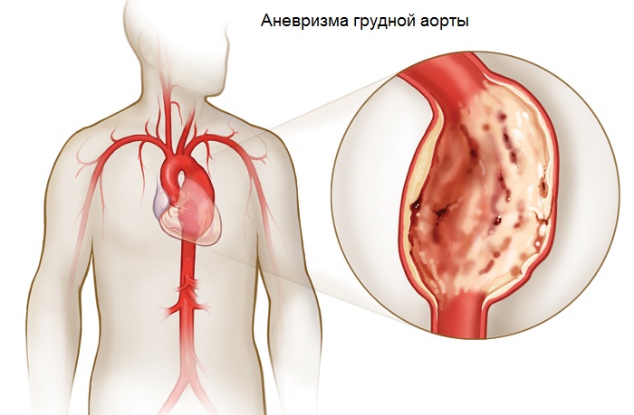 Аневризма аорты