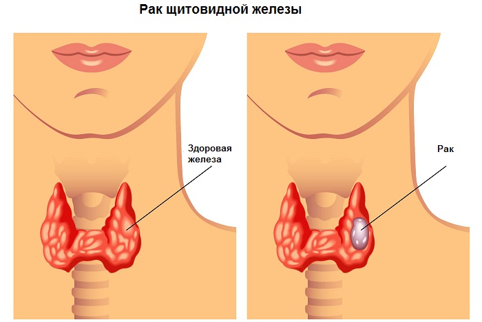 Рак щитовидки